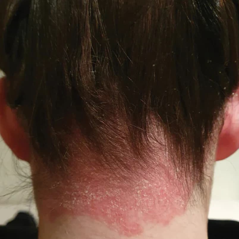 Irritated, flaky scalp before using The Daily Wash